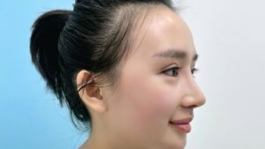 Nâng mũi cấu trúc hay bọc sụn tốt hơn? So sánh 6 tiêu chí chọn lọc