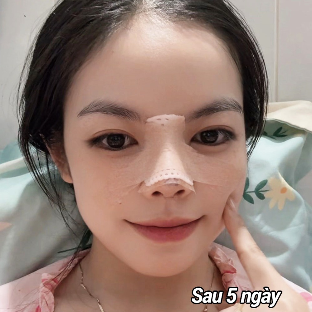 khách hàng sinh hoạt nhẹ nhàng bình thường sau nâng mũi 5 ngày với nẹp cố định sống mũi.