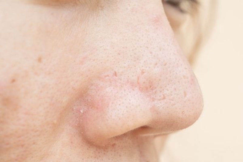 Người có cơ địa sẹo lồi sẽ dễ để lại sẹo sau khi nâng 