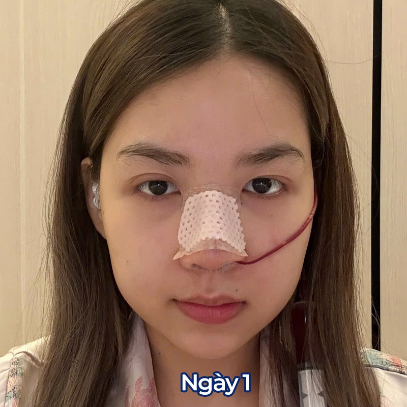 Mũi sưng nề sau ngày đầu nâng mũi do phản ứng của mô mềm