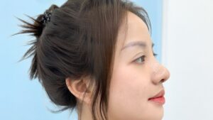 Nâng mũi có sưng không? Lộ trình 30 ngày gom form và cách phân biệt sưng tụ dịch