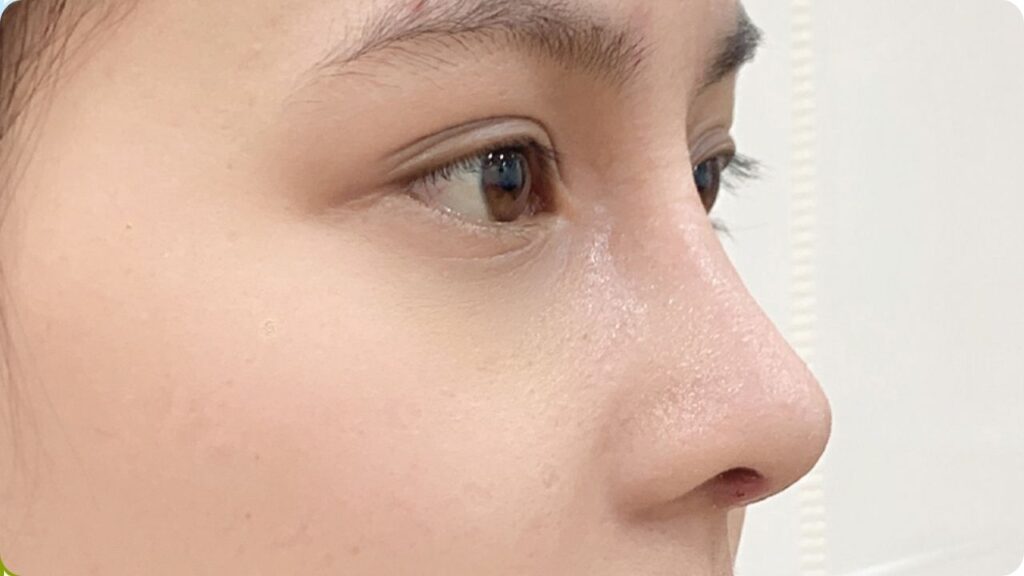 Nâng mũi bằng sụn có cộm không? Review cảm giác thực tế và 3 bí quyết để mũi mềm như thật