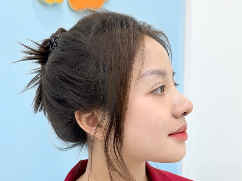 Khách hàng làm dáng mũi S line tự nhiên, hợp với đường nét trên gương mặt