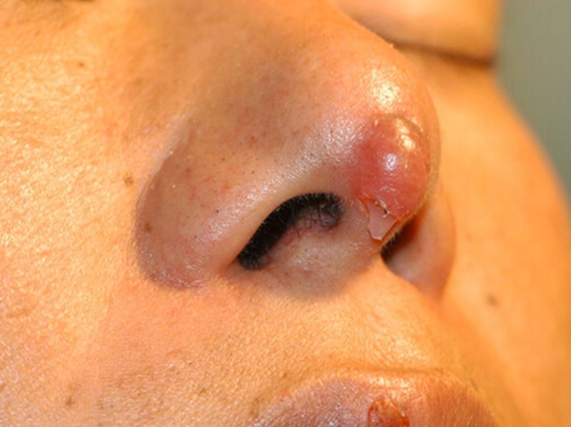 Mũi bị hỏng nhiều lần, có hiện tượng sưng tấy đầu mũi bắt buộc phải thực hiện gây mê tại bệnh viện.