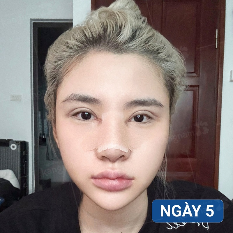 Bầm tím nhẹ sau nâng mũi là dấu hiệu bình thường, không nguy hiểm sức khỏe và sẽ giảm dần sau vài ngày