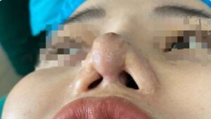Nâng mũi giá rẻ có an toàn không? 85% ca biến chứng bắt nguồn từ đây