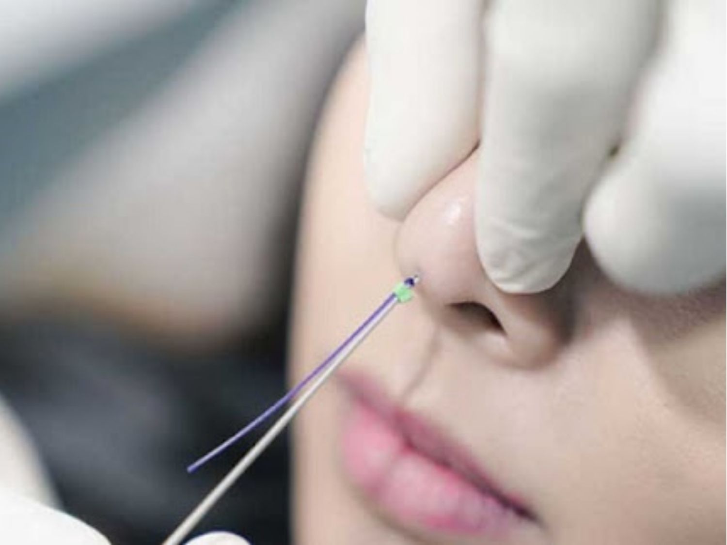 Bác sĩ sử dụng mũi kim nhỏ luôn chỉ vào trong mũi để nâng cao sống mũi