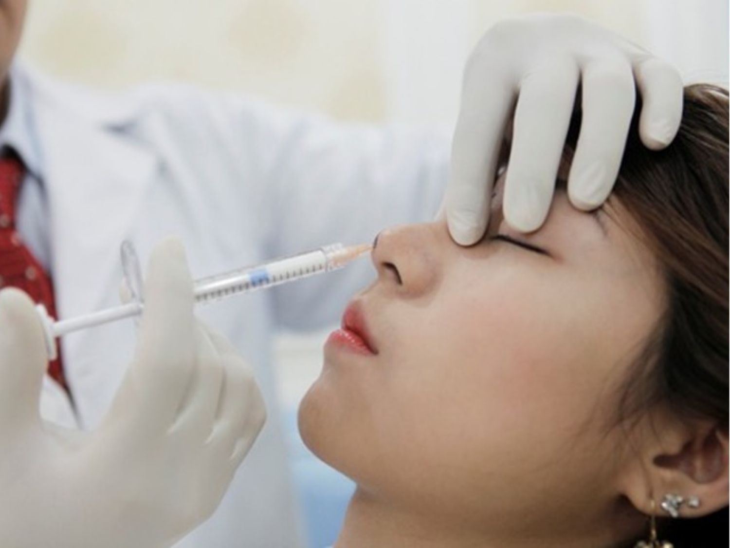 Nâng mũi không phẫu thuật bằng filler, bác sĩ đưa hoạt chất làm đầy vào mũi bằng kim tiêm nhỏ