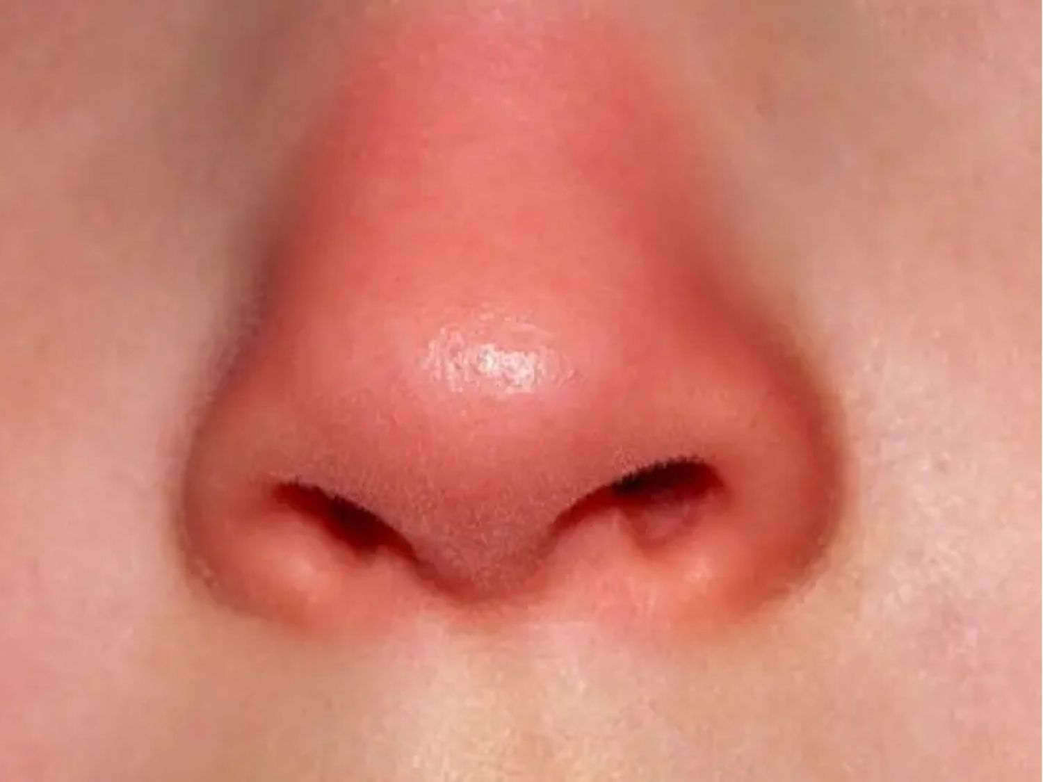 vùng mũi ửng đỏ, sưng nhẹ khi ăn quá nhiều thịt bò sau nâng mũi