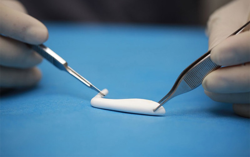 Sụn nhân tạo có tính linh hoạt, dễ định hình, được dùng để nâng mũi