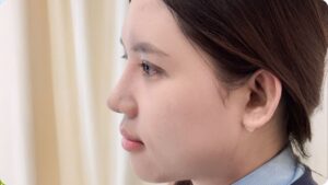 Kinh nghiệm nâng mũi lần đầu: 5 Lưu ý “xương máu” để tránh hối hận về sau