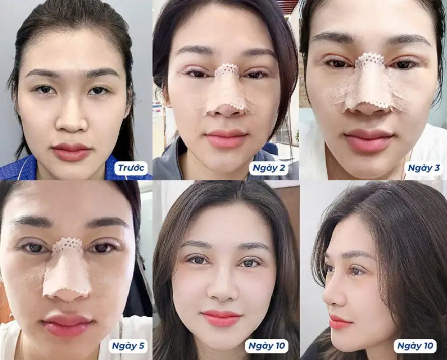 Nâng mũi trải qua nhiều giai đoạn từ chuẩn bị đến hồi phục lên form mũi chuẩn, tự nhiên