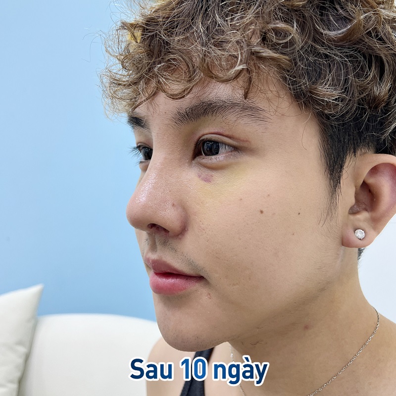 Với nam giới cần chọn dáng mũi nam tính, cân đối