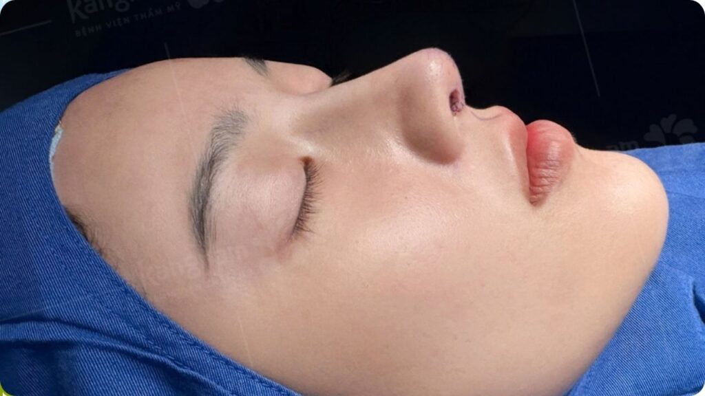 So sánh nâng mũi phẫu thuật và không phẫu thuật: Giải pháp nào bền vững?