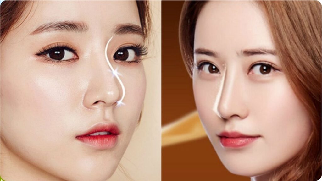 So sánh nâng mũi S-line và L-line: Dáng mũi nào đẹp và bền vững nhất?