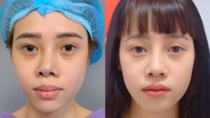 Nâng mũi sửa lại: Kỹ thuật tái cấu trúc bao xơ và khắc phục biến chứng chuẩn y khoa