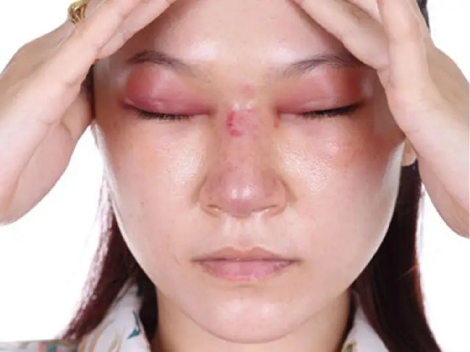 Hiện tượng sưng bất thường sau nâng mũi, vùng mũi sưng, tấy đỏ lên cả mắt, cơ thể mệt mỏi