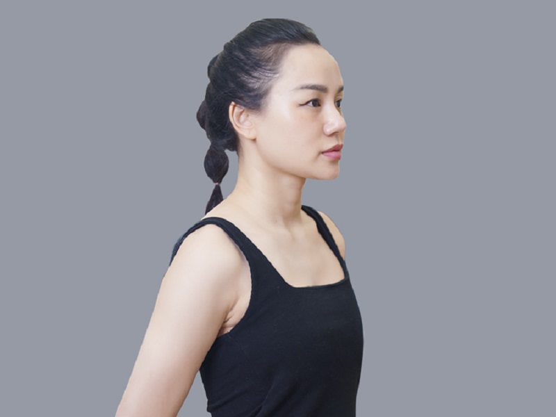 Sự thay đổi tự nhiên của mô tuyến vú và vị trí túi độn sau 10 năm do tác động của trọng lực.