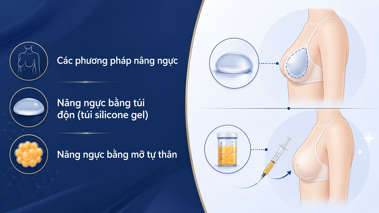 ảnh mô tả Các phương pháp nâng ngực phổ biến hiện nay