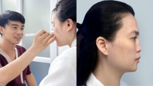 Review các phương pháp nâng mũi 2026: Từ bọc sụn đến cấu trúc sụn sườn – Giải pháp nào cho bạn?
