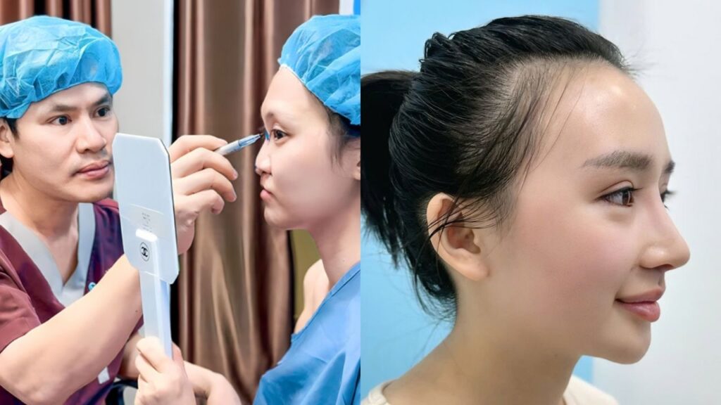 Nâng mũi có đau không? Review 5 phương pháp ít đau và Lộ trình hồi phục