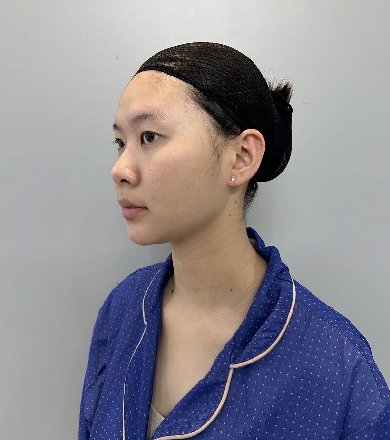 Thanh Thảo gặp tình trạng mũi thấp, cánh mũi to bè