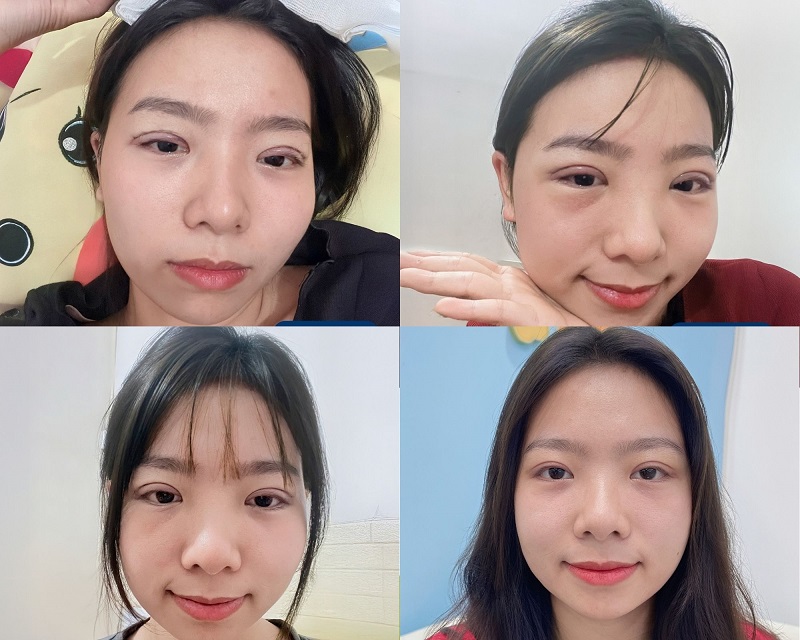 Giai đoạn phục hồi sau cắt mí chuẩn Y khoa