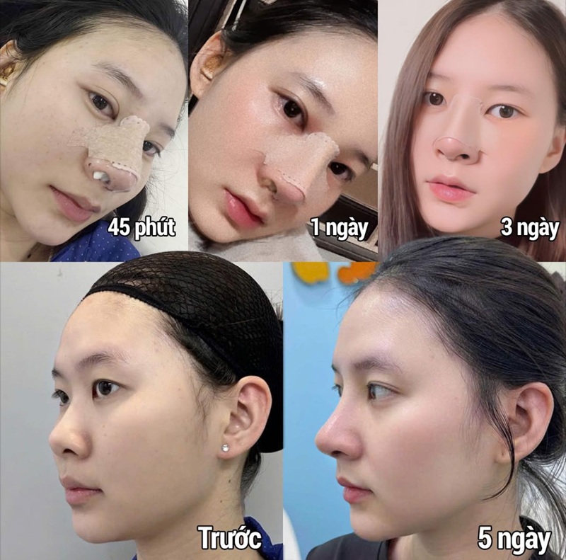 Quá trình nâng mũi theo từng giai đoạn trước và sau khi nâng đến khi hồi phục hoàn toàn, mũi lên dáng chuẩn form 