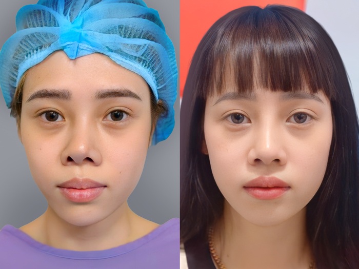 Sau khi sửa mũi hỏng, khách hàng tự tin với form mũi chuẩn, cao thẳng đứng hài hòa với khuôn mặt giúp nâng cao sự tự tin