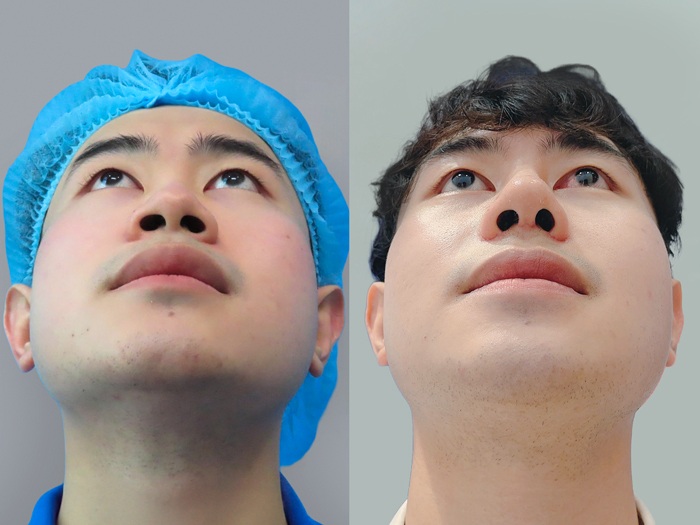 Dáng mũi cao thẳng tắp sau khi nâng giúp tôn lên đường nét khuôn mặt giúp khách hàng tự tin hơn