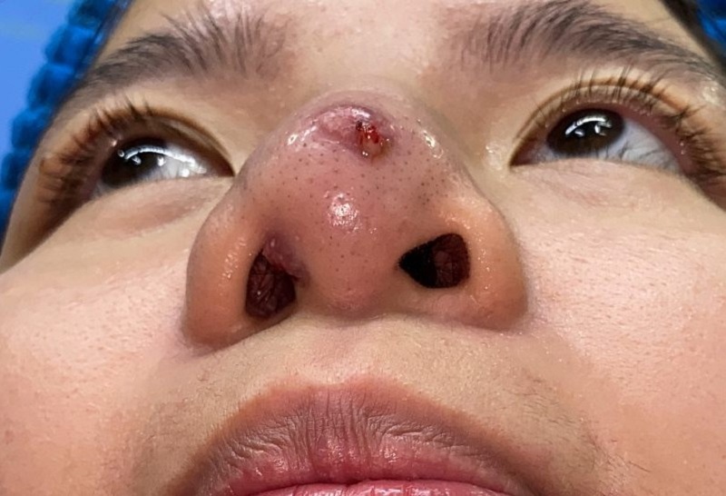 Mũi bị nhiễm trùng, lộ sống mũi