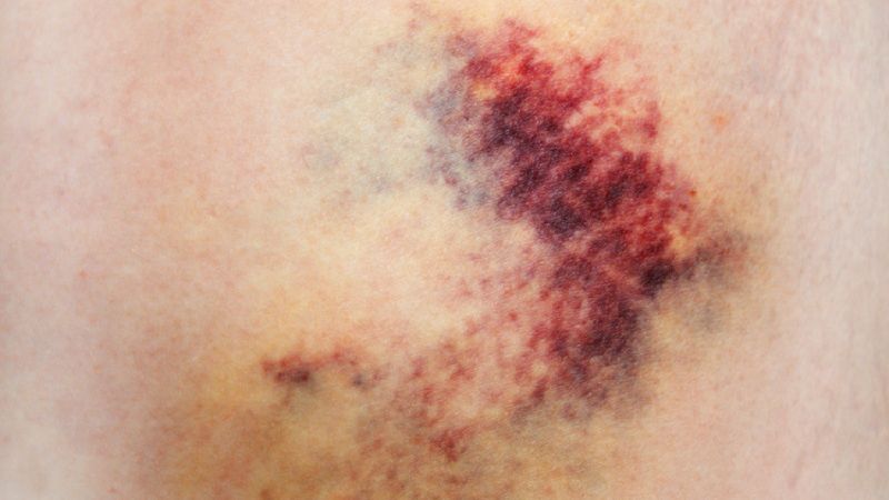 Vùng hút mỡ có dịch màu vàng nhạt hoặc hồng nhạt thấm ra từ vết trích hút mỡ