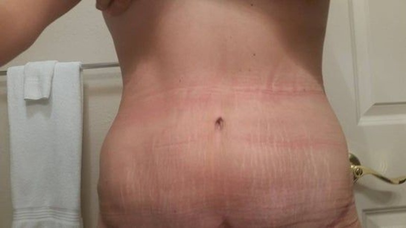 Da vùng đó sưng nóng, khó chịu cần phải đi tái khám ngay