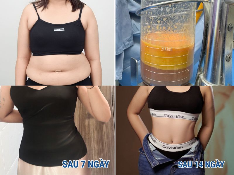 Mô phỏng giai đoạn hồi phục sau hút mỡ vùng sau 7 ngày hiệu quả, an toàn