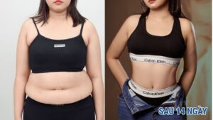 Sau hút mỡ đau mấy ngày? Timeline hồi phục và cách giảm đau thần tốc
