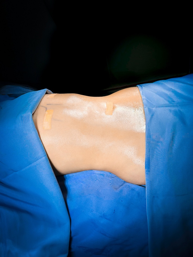 Khi vừa hút mỡ vùng thực hiện vẫn sẽ sưng, hơi tấy