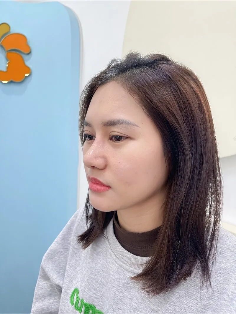Khách hàng Phương Hằng chọn nâng mũi S-line tại Kangnam sở hữu dáng mũi mềm mại tự nhiên