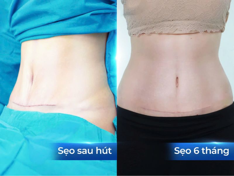 Hình ảnh sẹo sau 6 tháng thực hiện dịch vụ giảm mỡ + tạo hình thành bụng