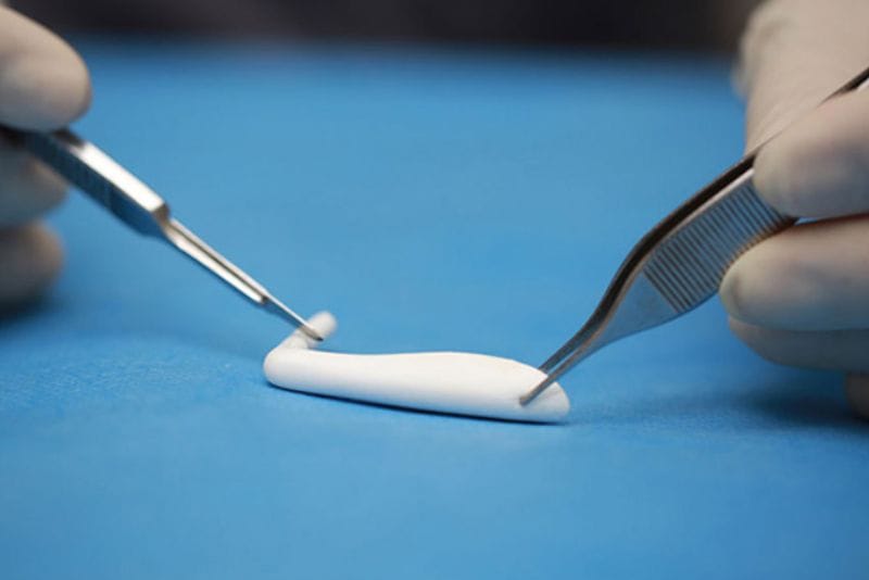 Đa dạng các loại sụn nâng mũi trên thị trường hiện nay, phổ biến là sụn nâng mũi tự thân và nhân tạo