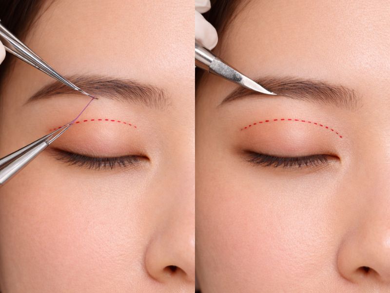 Sự khác biệt về độ dài đường rạch giúp Mini Deep giảm thiểu sưng bầm và hồi phục nhanh hơn.