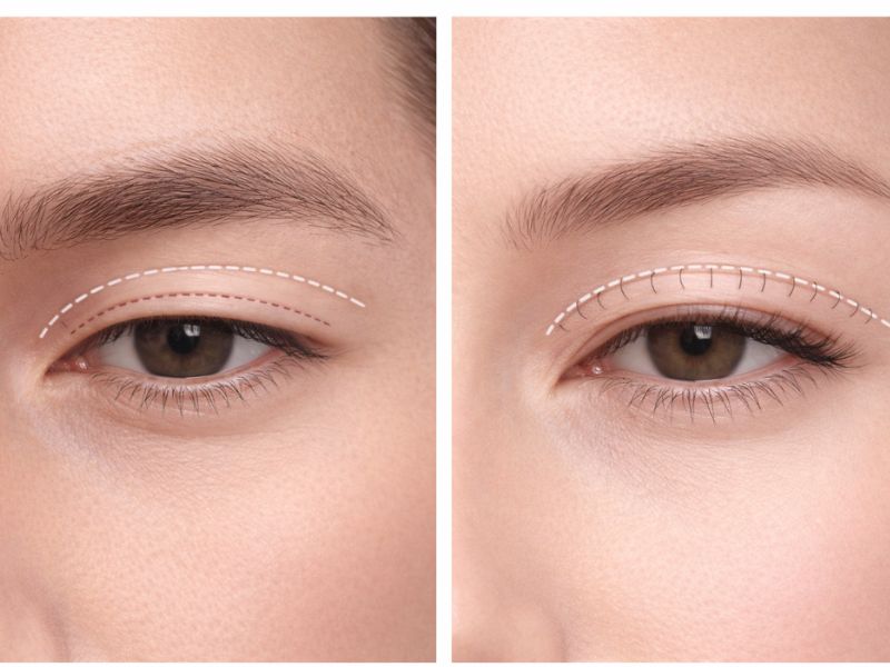 Sự khác biệt về cấu trúc xương và da mí mắt giữa nam và nữ ảnh hưởng trực tiếp đến kỹ thuật tạo hình nếp mí.