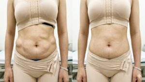 Sửa hút mỡ hỏng: Giải pháp tái cấu trúc mô và Thời điểm vàng để chỉnh sửa an toàn