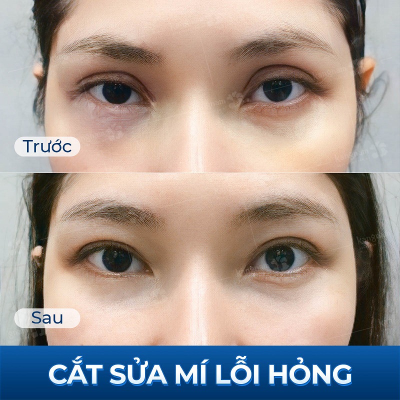 Chỉnh sửa trợn mí đúng thời điểm giúp mí mắt tự nhiên hơn