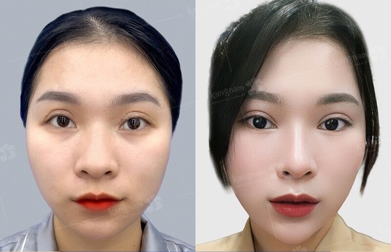 Phẫu thuật cắt mí để chỉnh sửa lại mí bị lỗi hỏng