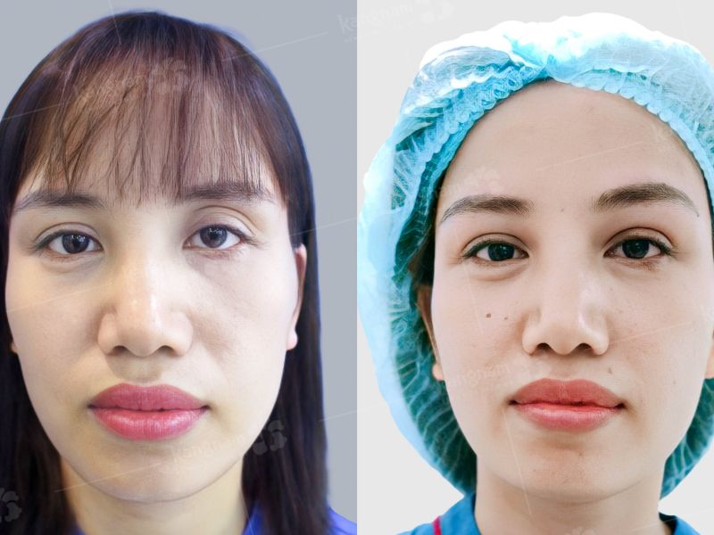 Mí mắt được sửa lại, cân đối và ổn định hơn