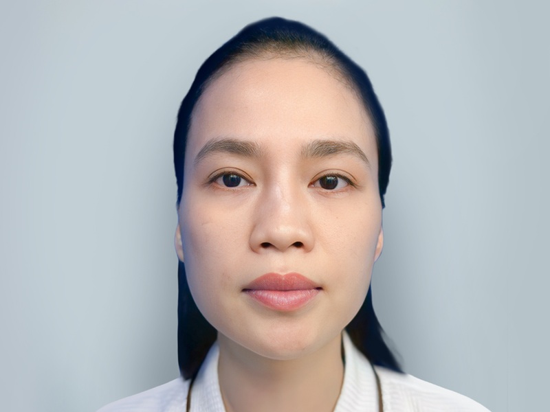 Mũi bị lệch vẹo sau khi nâng cần phải chỉnh sửa lại để hài hòa với khuôn mặt