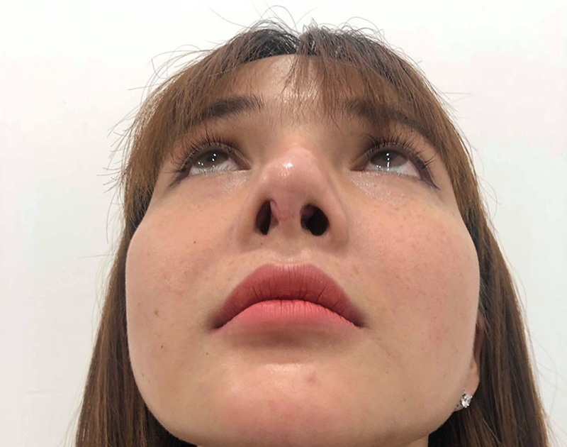 Sụn nhân tạo bị đào thải do chăm sóc không đúng cách dẫn tới đầu mũi bị lộ