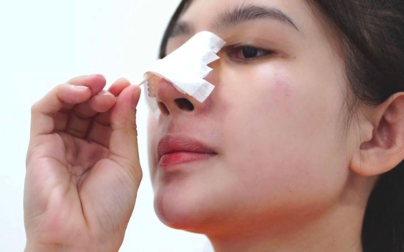 Vệ sinh mũi sạch sẽ bằng tăm bông để hạn chế chạm vào vùng mũi sau khi nâng