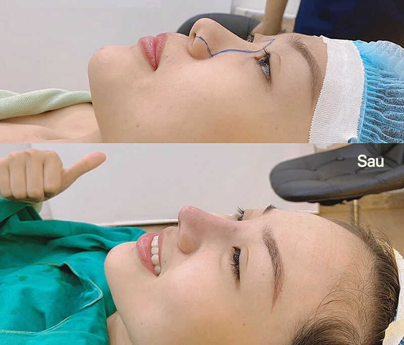 Nâng mũi cấu trúc được đánh giá là phương pháp ít biến chứng nhất, giúp mũi chuẩn form cao và nhìn tự nhiên 
