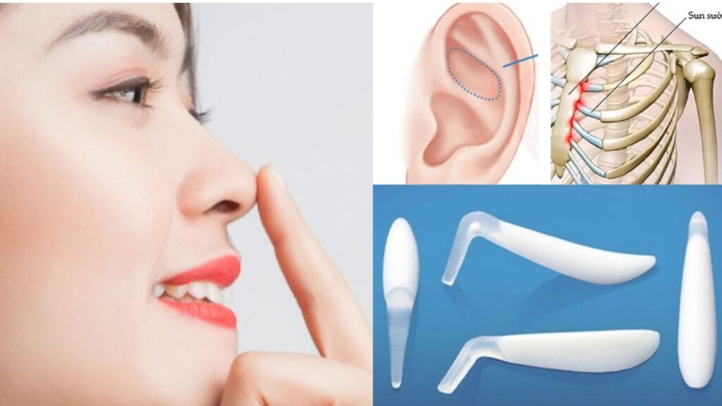Sụn nâng mũi nào ít biến chứng nhất? So sánh từ góc nhìn bác sĩ